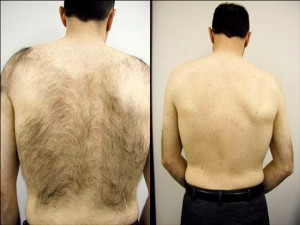 Trajna epilacija - Lumenis Light Sheer Duet laser