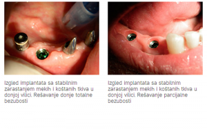 Implantologija