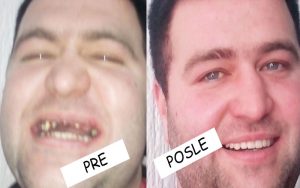 Metalokeramički mostovi